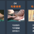 【招募志愿者】“脫發(fā)”有救了！ 隨州市中心醫(yī)院醫(yī)療美容科面向社會招募“毛發(fā)移植”體驗者！