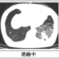 隨州市中心醫(yī)院：【特色技術(shù)】微創(chuàng)技術(shù)新突破，冷凍消融治療精準(zhǔn)“凍殺”癌細(xì)胞