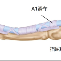 隨州市中心醫(yī)院【特色技術(shù)】超聲引導(dǎo)小針刀松解術(shù) 告別“扳機(jī)指”困擾